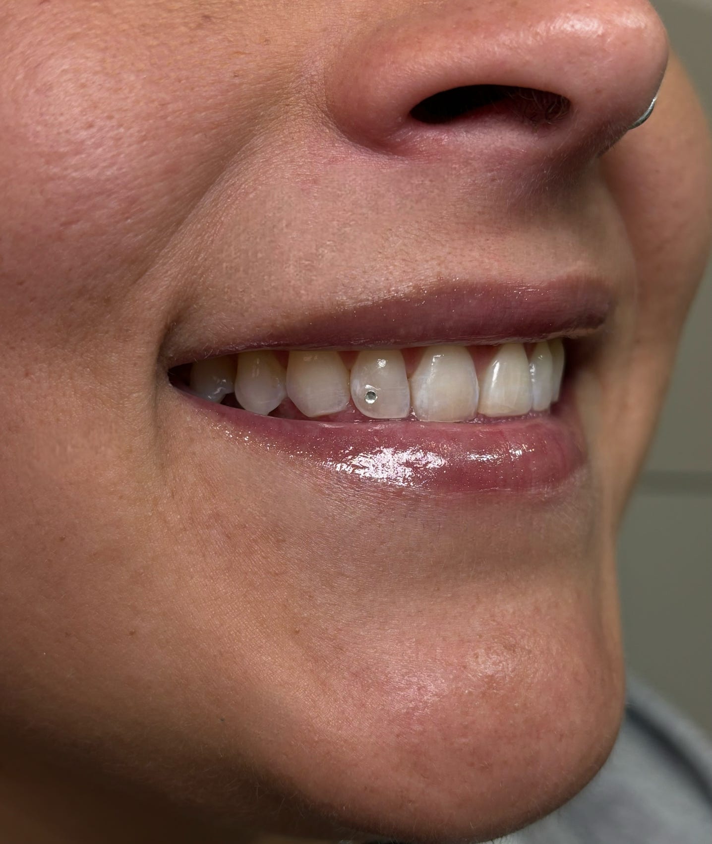 Gemas dentales en Badalona. Dale un toque de brillo y personalidad a tu sonrisa con total seguridad.